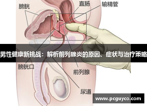 男性健康新挑战：解析前列腺炎的原因、症状与治疗策略